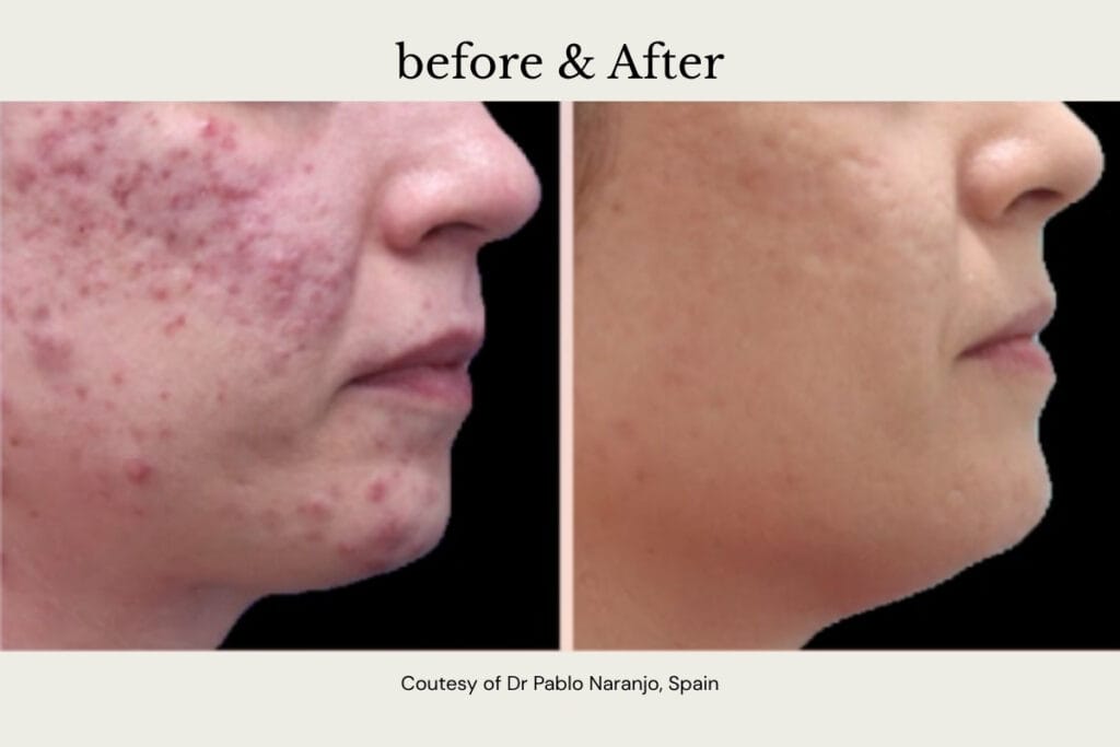 before and after acne treatment with Alma harmony