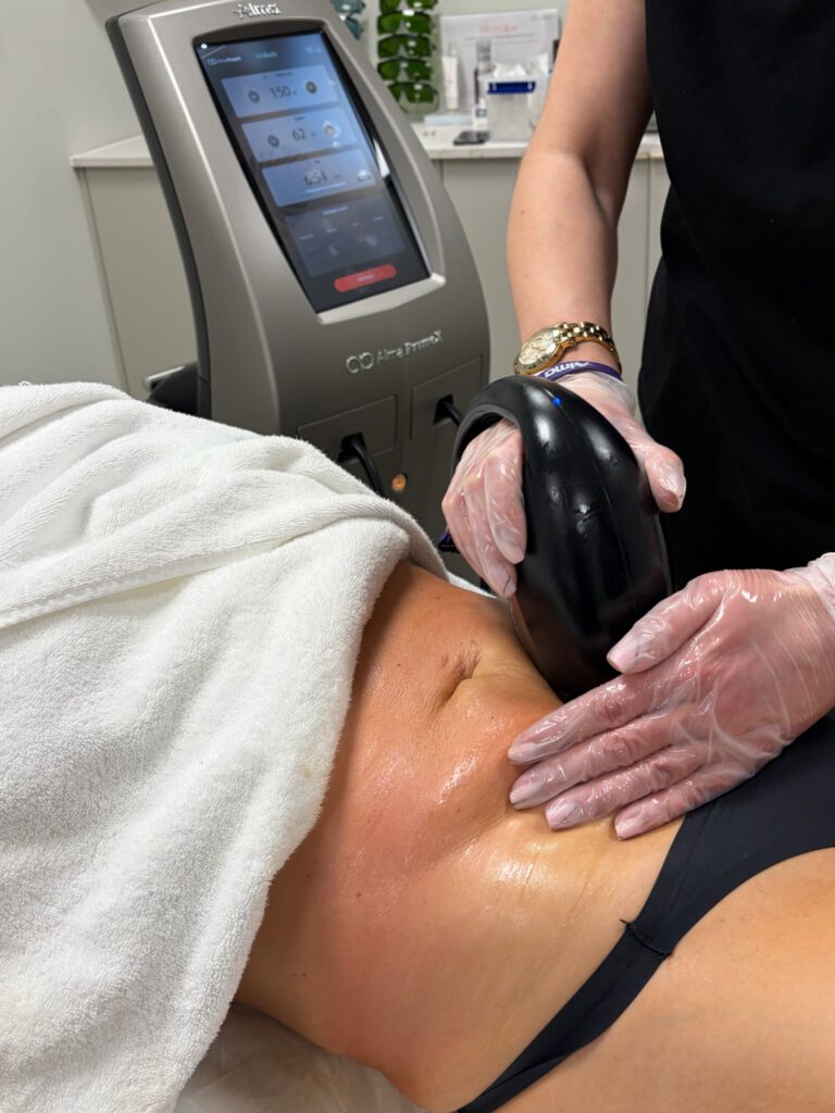 Tighten the stomach with Alma laser technology