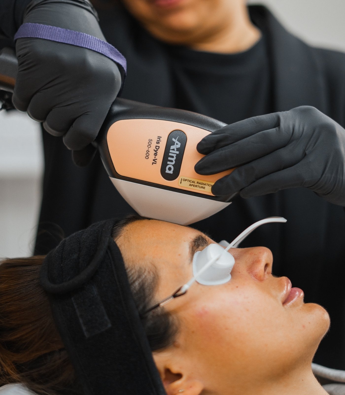 IPL treatment for rosacea