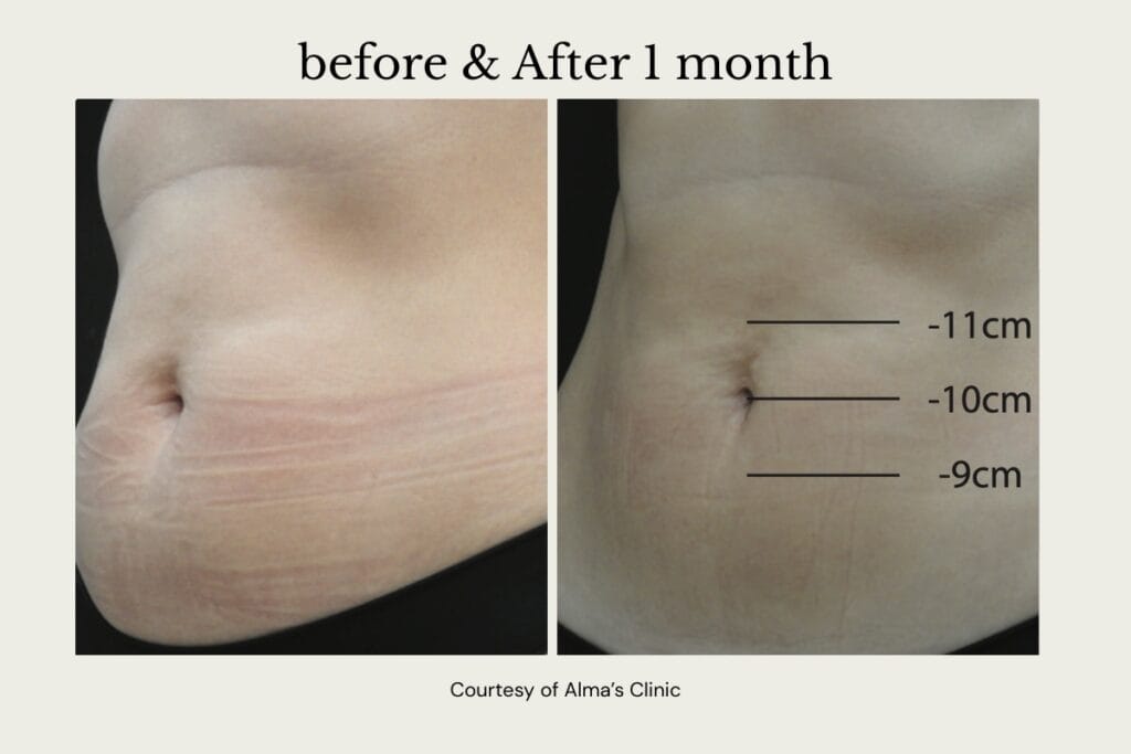 before and after alma primex skin tightening treatment on the abdomen