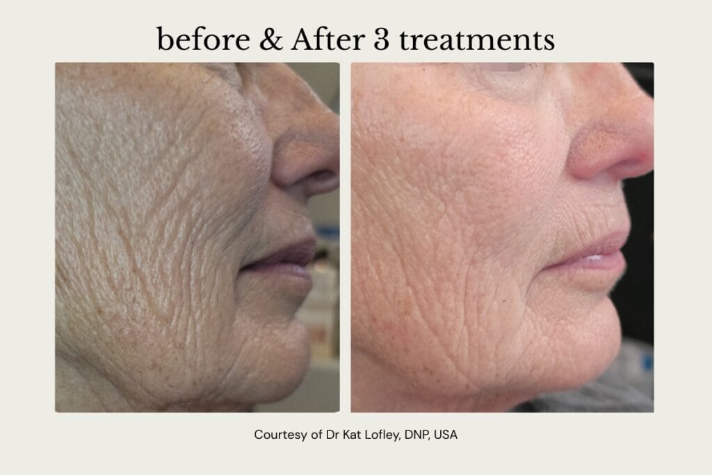 Before and after Alma PrimeX treatment for skin texture and wrinkles