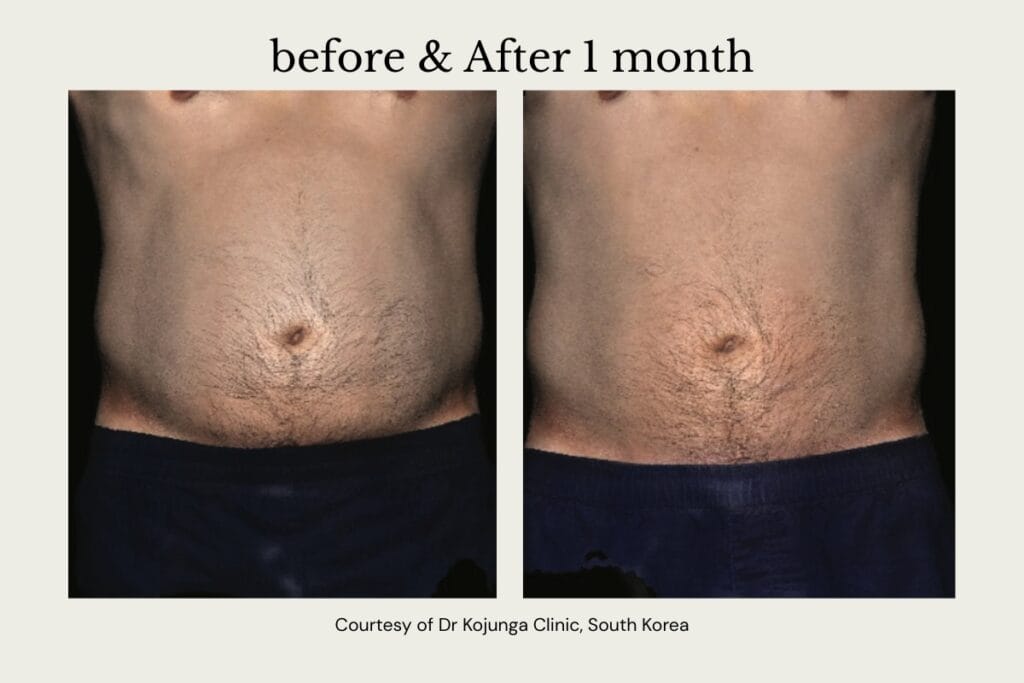 before and after Alma PrimeX for localised stomach fat
