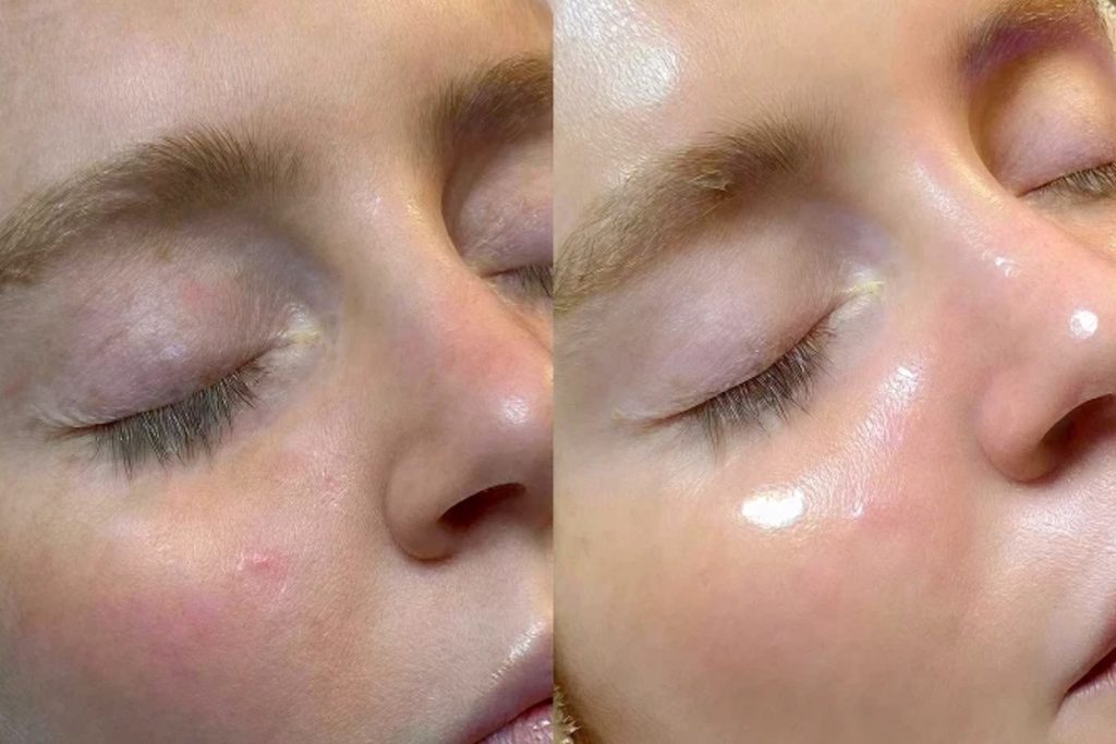 before and after hydrafacial treatment