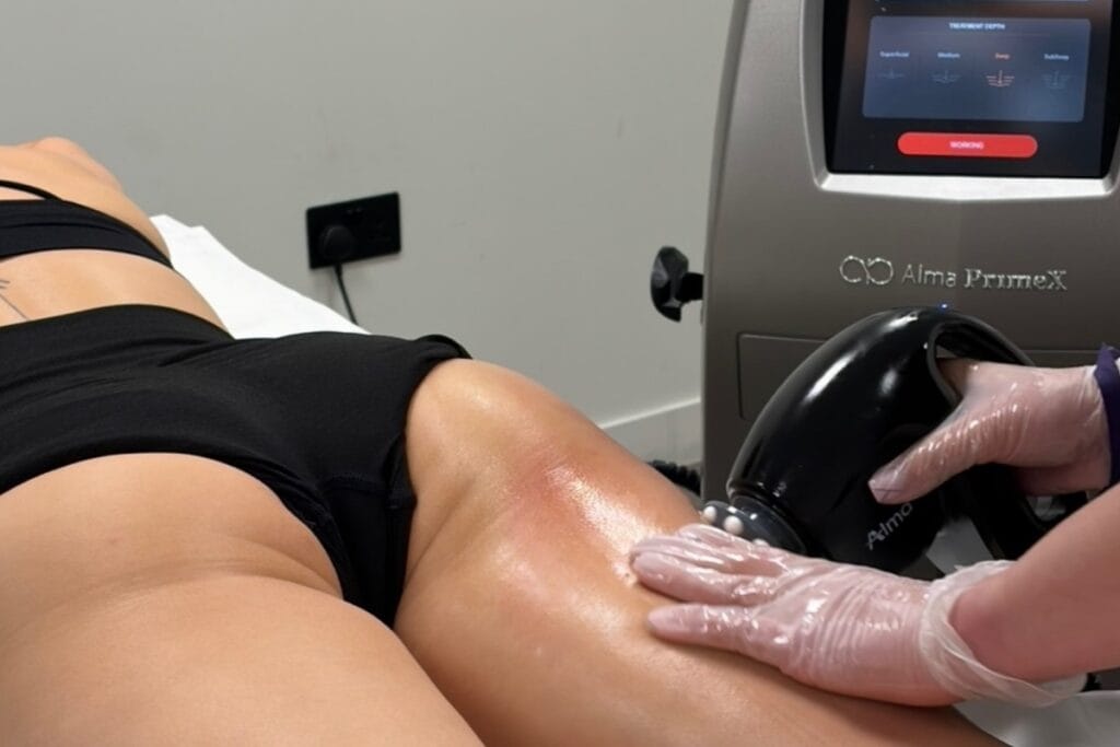 Non-surgical BBL treatment at Smooth Dimensions Essex